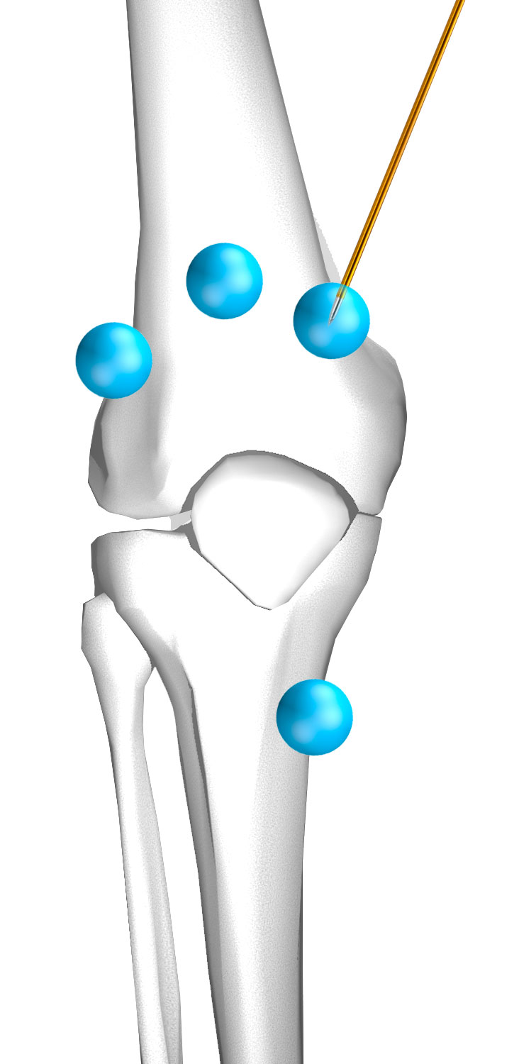 Accurian™ in knee procedures