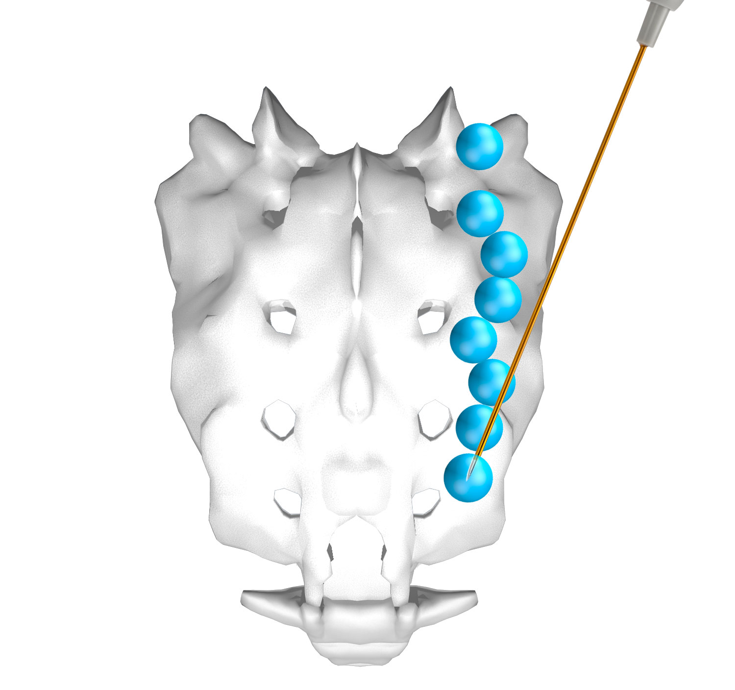 Accurian™ in sacral spine procedures