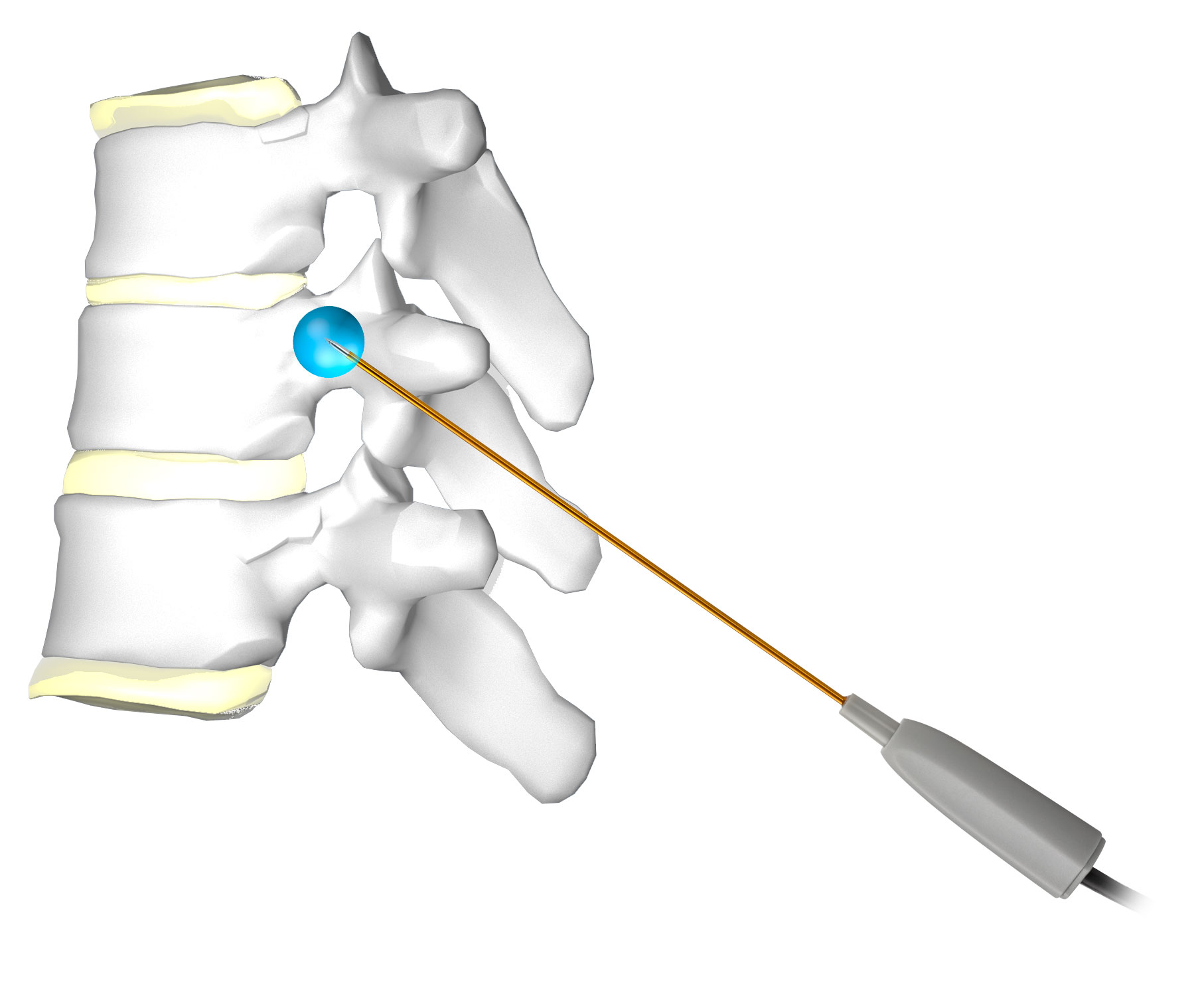 Accurian™ in thoracic spinal procedures