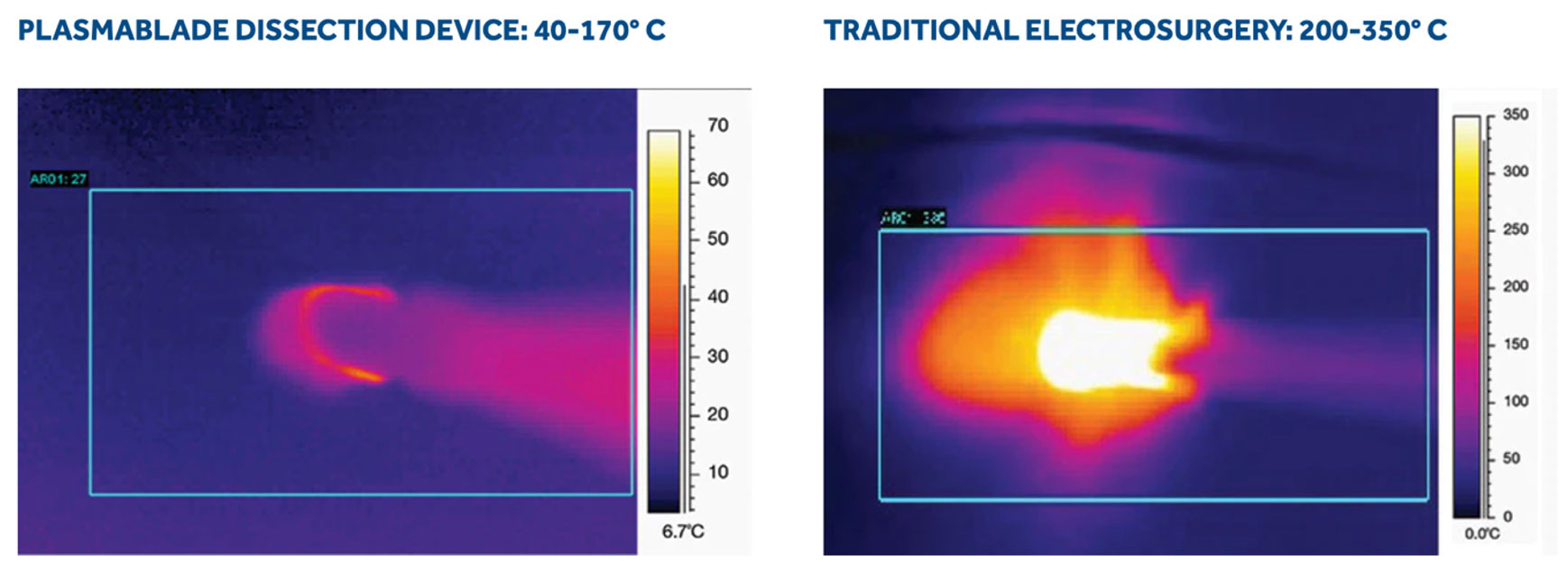 Plasmablade Dissection Temperature vs Traditional Electrosurgery