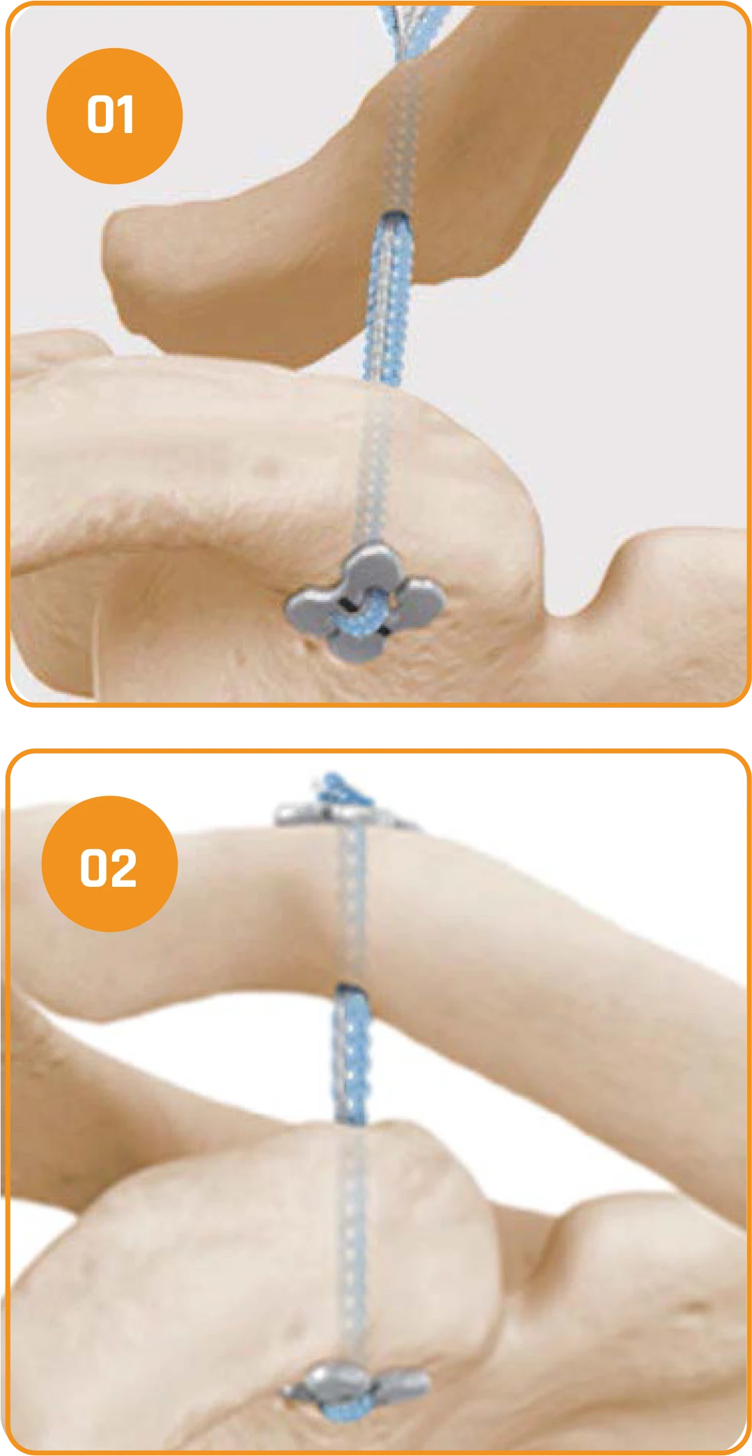 Fixed Suture Button - FlipLock
