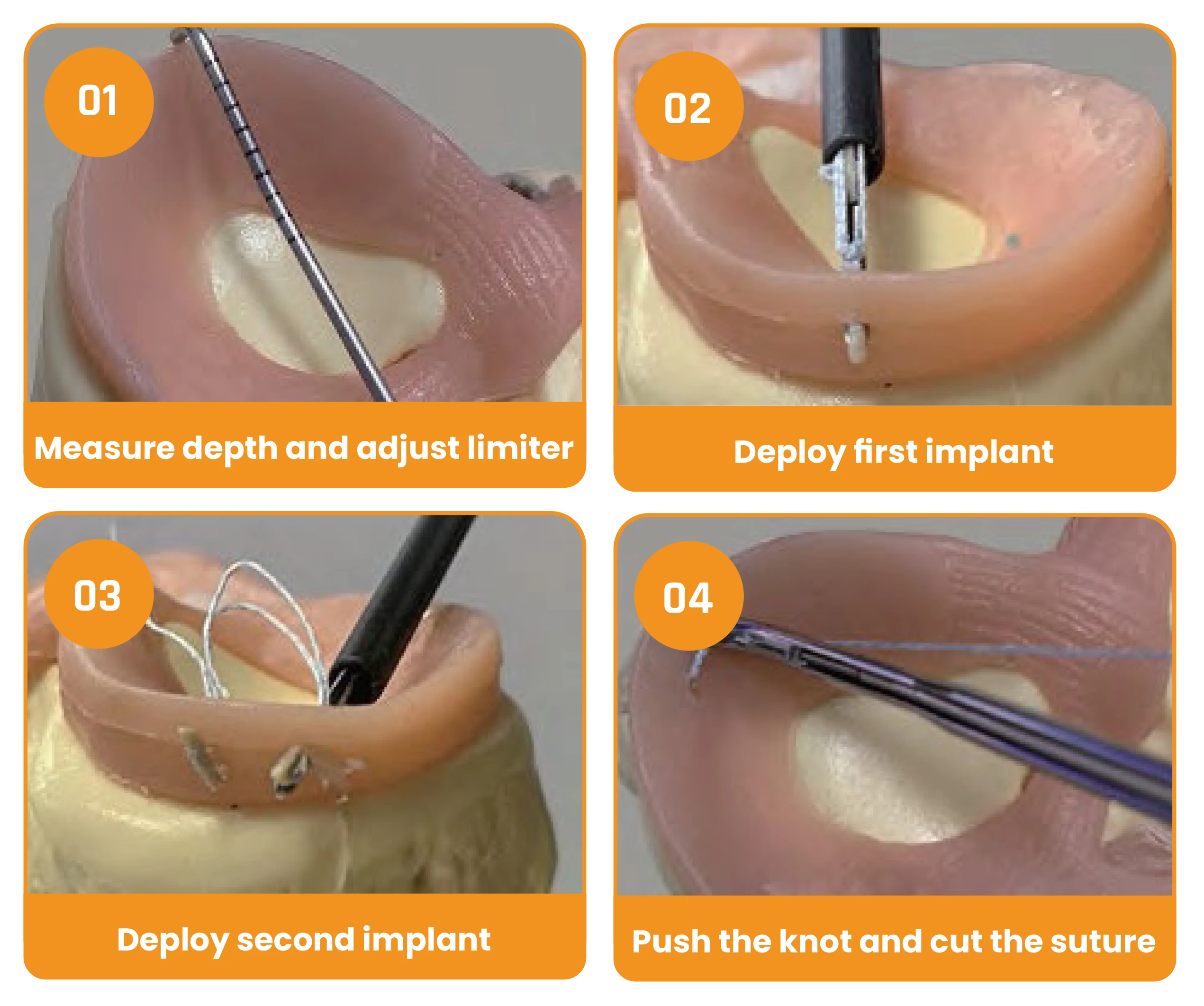 AccurFix Meniscal Repair - Operation Steps