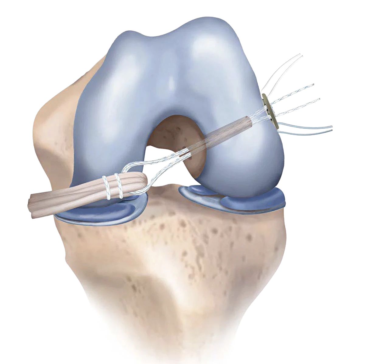 Adjustable Suture Buttons in a knee joint diagram 