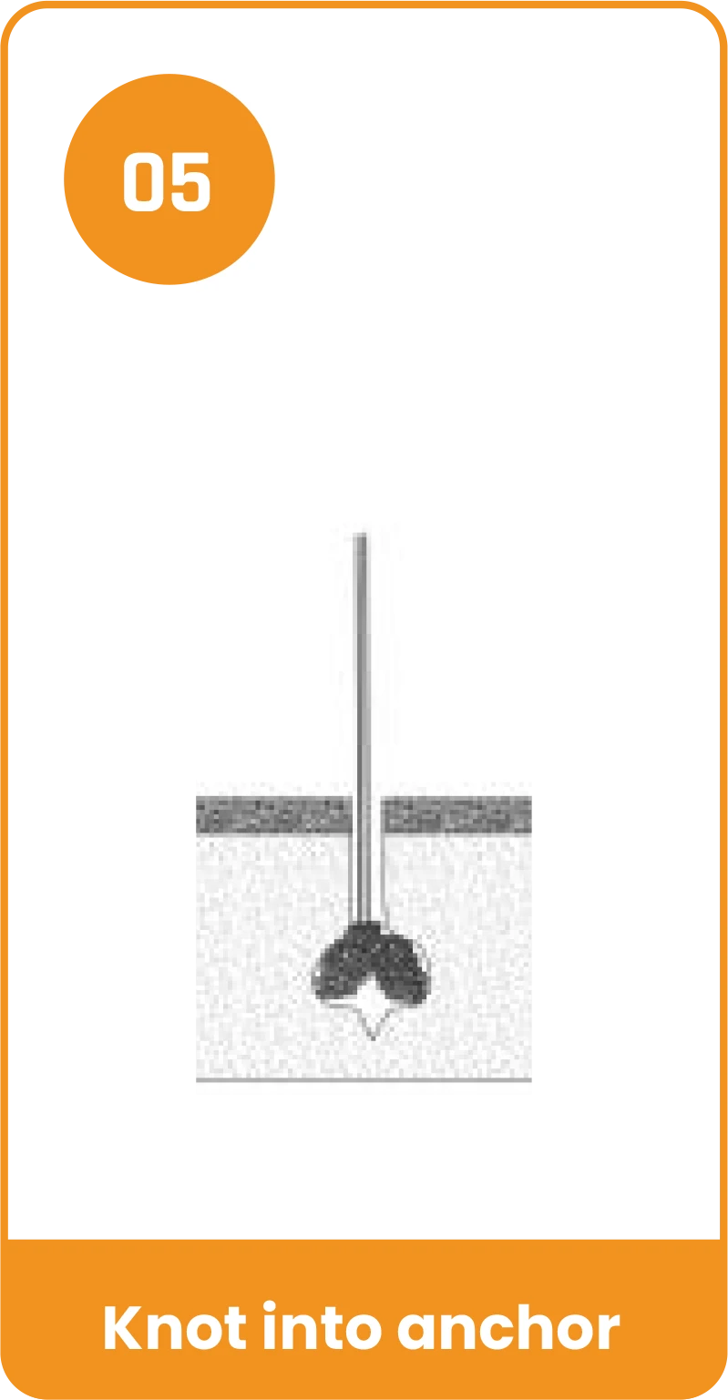 Y-Fix All Suture Anchor - Knot into anchor